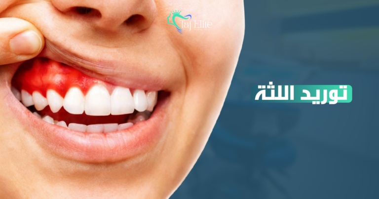 توريد اللثة